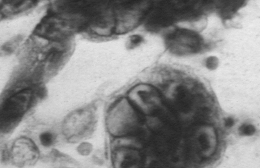 Muestra histológica del herpesvirus simple tipo 1, uno de los viris que la nueva tecnología ha permitido diagnosticar. 