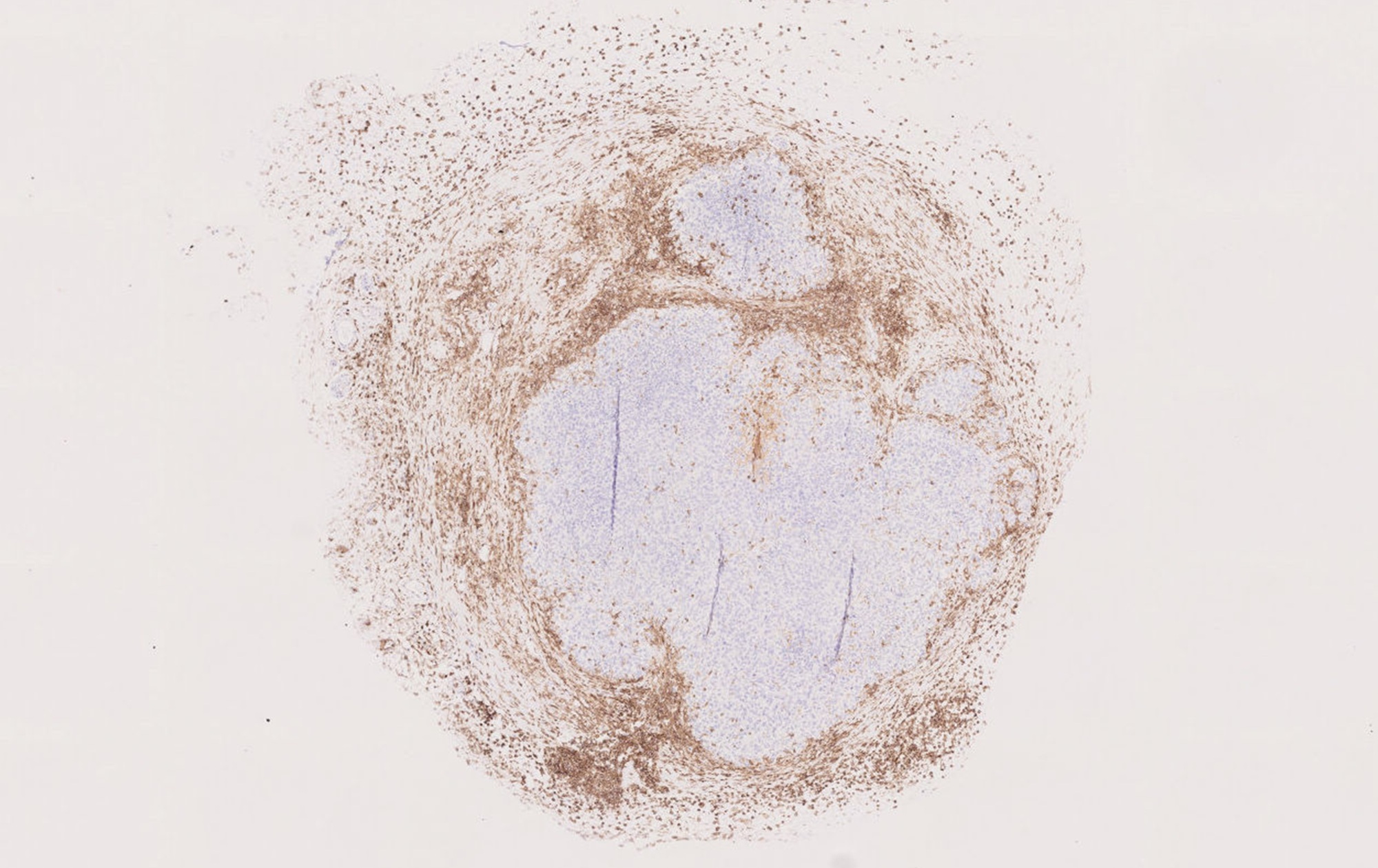 Imagen de un tumor de sarcoma de Ewing (teñido de color azul claro) tratado con la terapia, rodeado de células del sistema inmune (teñidas aquí en color marrón).