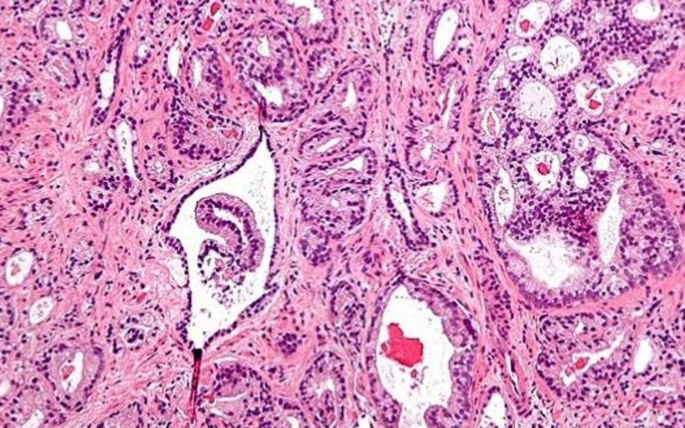 Histología de células tumorales en cáncer de próstata.