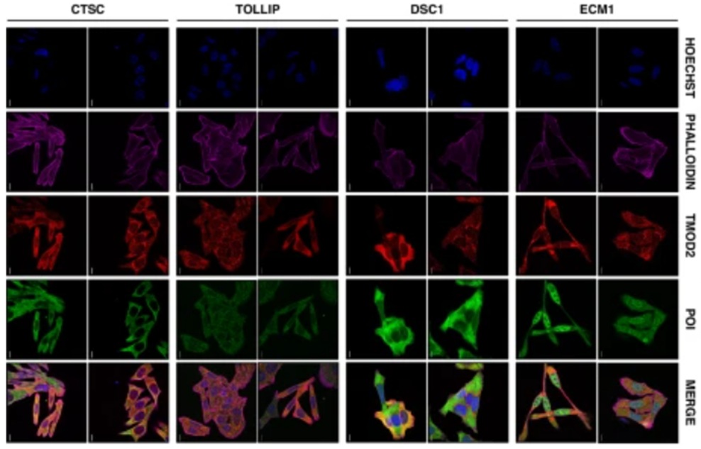 Análisis celular por inmunofluorescencia, que confirma la colocalización de la proteína TMOD2 en diversas proteínas de su interactoma, que favorece su implicación en la tumorogénesis y la metátasis del cáncer (imagen extraída del artículo publicado por el equipo de la UFIEC-ISCIII).
